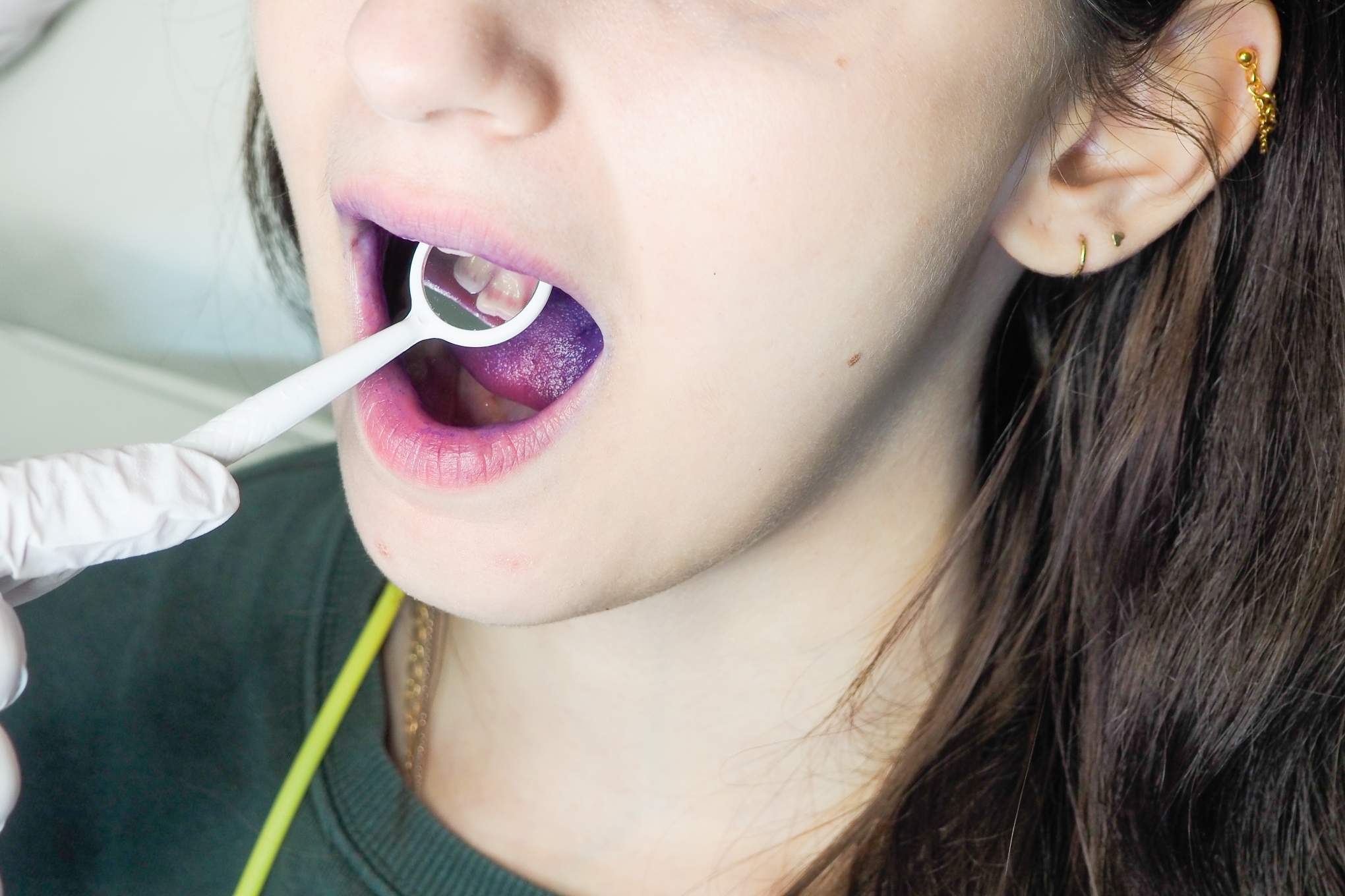 Henkilöllä on suussaan hampaiden tarkasteluun tarkoitettu pieni peili.