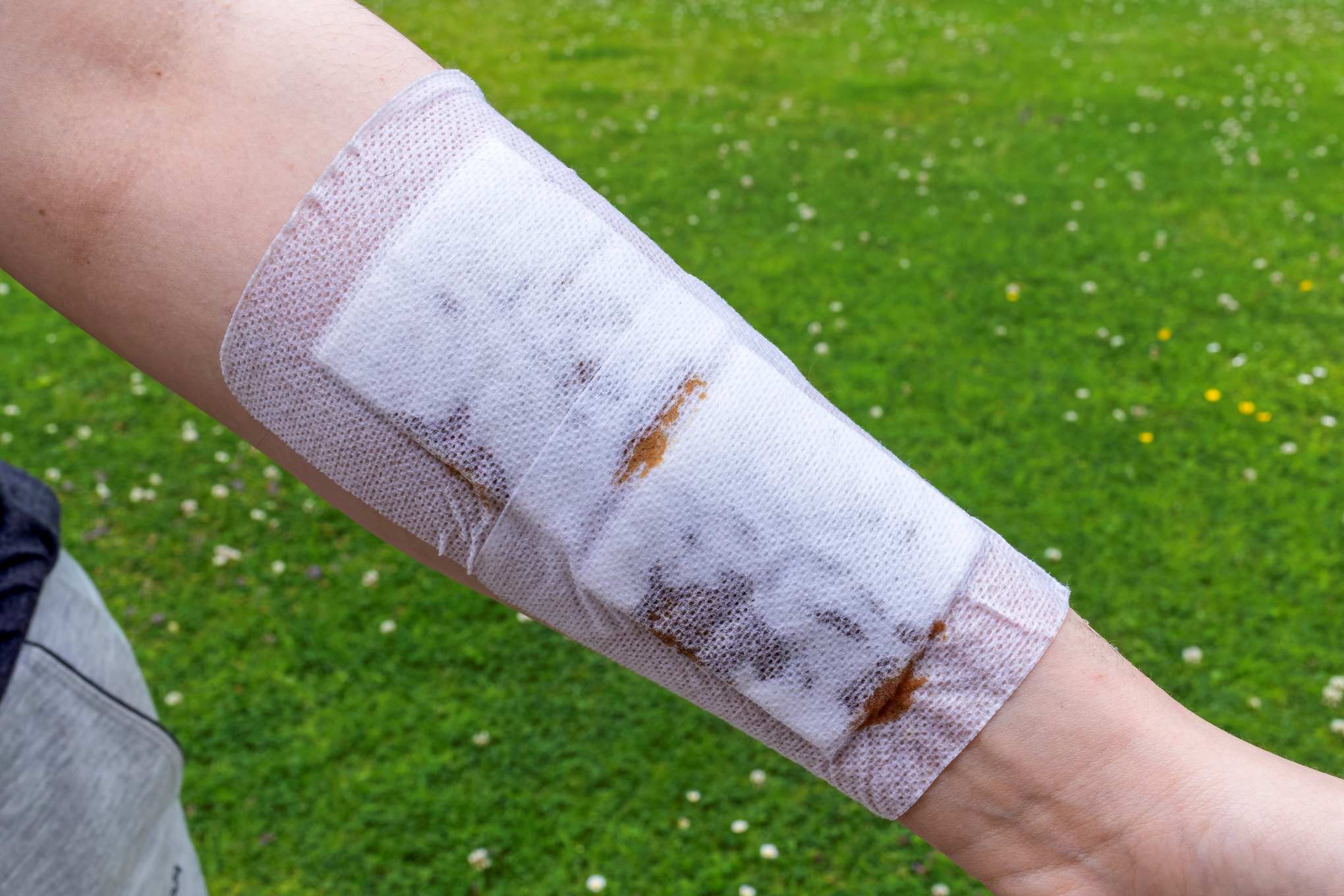 Henkilön kädessä on haavasidos.